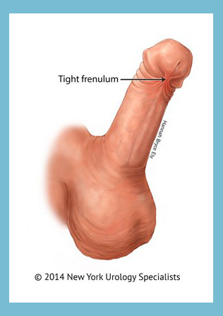 Penis frenectomy